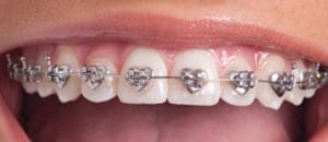 wlds-types-of-braces-heart