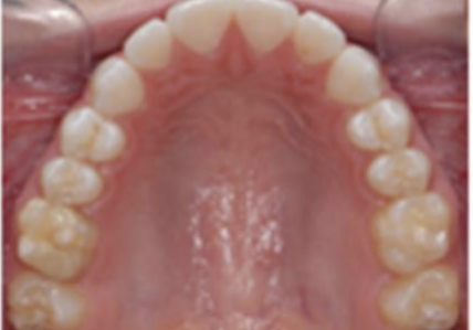 Top teeth example
