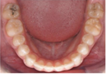 Bottom teeth example